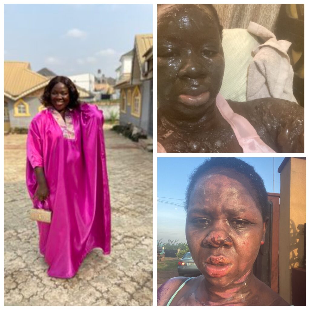 Nigerian burn survivor shares new photos months after a gas explosion nearly left her blind || Peakvibez.com